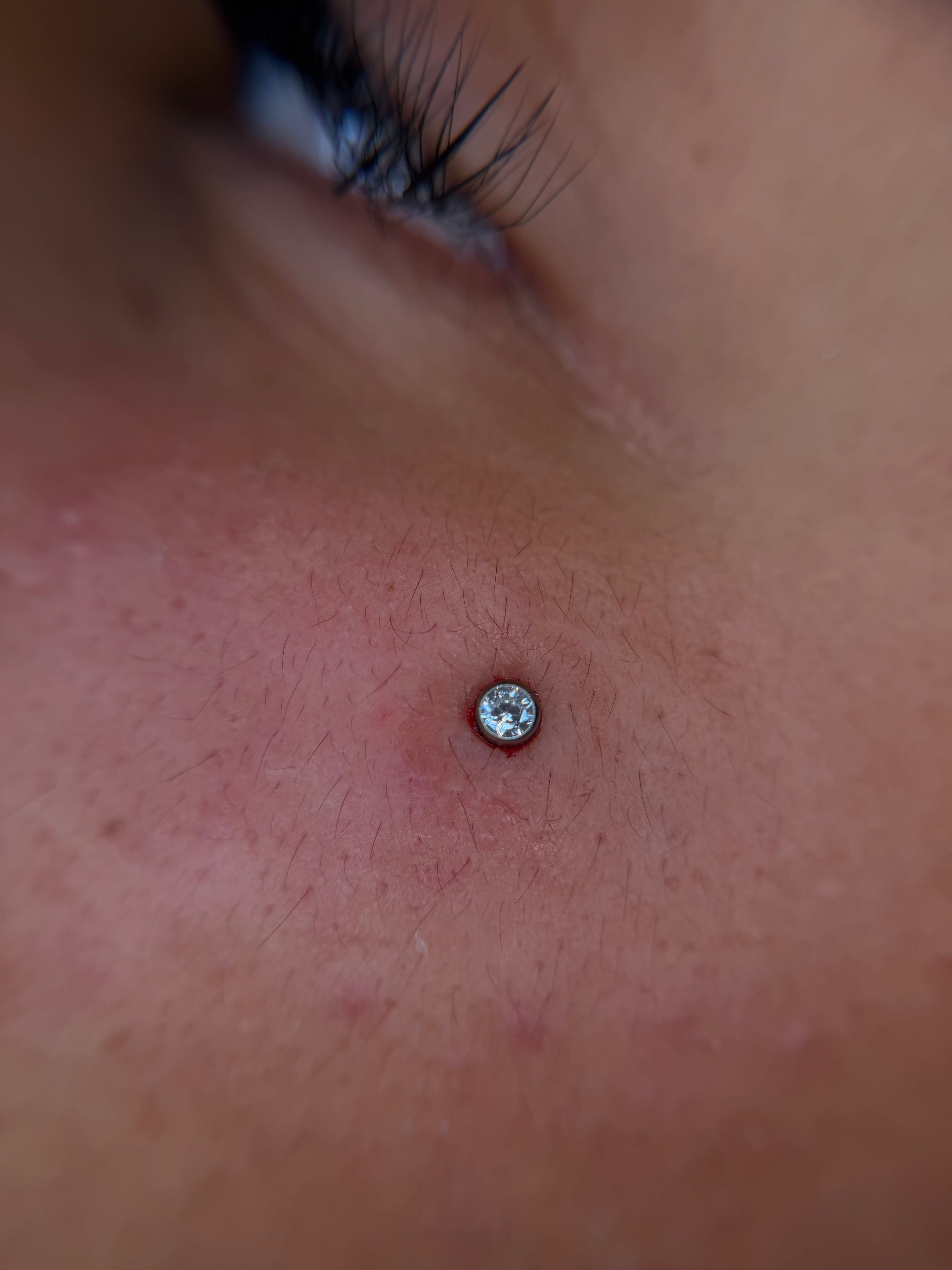 Topos microdermal